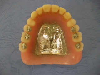 総義歯(総入れ歯)金属床